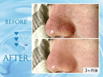 クリアラボ 池袋2nd(Clear Lab)/韓国肌管理&毛穴洗浄専門店