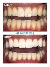 ララホワイトニング/Before&After強力ホワイトニング