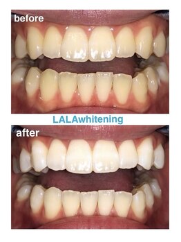 ララホワイトニング/Before&After強力ホワイトニング