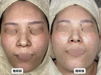 エングラッシー(en glassy)/BEFORE　AFTER　最新シミ回収