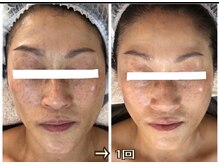アルページュ(Arpege)の雰囲気（チタニウムリフトで女優スキン弛み改善/色白小顔/シミケア顔短縮）
