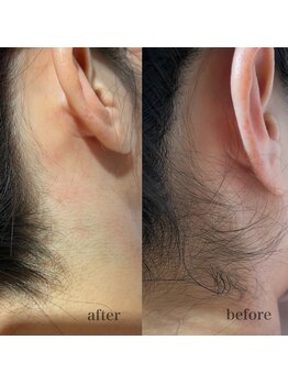 シャルム ド ケー(charme de k)/うなじ脱毛