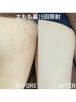 ココ(Coco)/メンズ脱毛　足