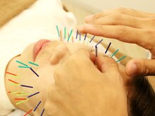 ウル鍼灸整骨院/美容鍼