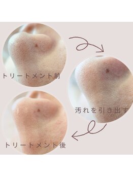 エミア(Emia)/黒ずみ・ザラ付に韓国式毛穴洗浄