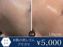 リベルテ(Liberte)の雰囲気（シミケア始めました！肌のトーンアップ◎若々しい見た目に！）
