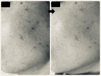 エフェクト 塚口店(effect)/Before After 50代/1回目