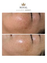 ロイヤル(ROYAL)/VVSダイヤモンドピーリング1回目