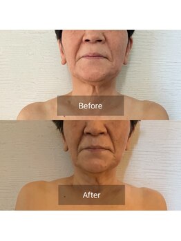 ココル(COCORU)/年齢で諦めない！あご下スッキリ