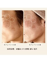 ル ボヌール/IPL光フェイシャル　1回の効果◎