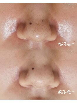 オレオマ(OLEOMA)の写真/デパコス使っても変わらなった毛穴ここまで変わる。