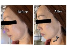 ブランシュール/小顔タイト×エンビロン