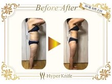 カワイ ビューティーサロン 新宿西口店(Kawai Beauty Salon)/【ハイパーナイフ】before/after