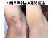 エナ バイ アオヒゲ(ena by AOHIGE)/レディース脱毛/ワキ脱毛