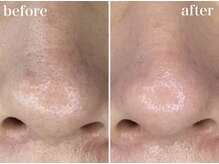 ホワイトアクア 京橋店(WHITE AQUA)/毛穴洗浄