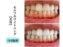 ベルホワイト(Belle White)/【美容W.N/1回】