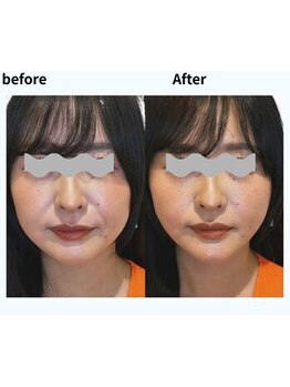 ラグラン銀座メディカルエステ 高輪ゲートウェイ店/たるみ・シワ・ハリ不足改善