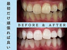 ホワイトニングショップ 八王子店/ホワイトニングビフォーアフター
