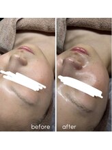 ビズエー(viz.A)/ダーマクチュール