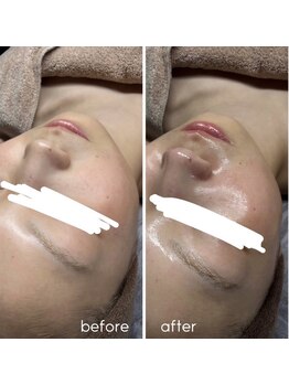 ビズエー(viz.A)/ダーマクチュール