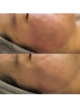 アルメ(arme)/【赤ら顔改善改善】