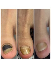 ドクターネイル爪革命 十条店/肥厚爪ケア