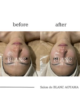 サロン ド ブラン アオヤマ(Salon de BLANC AOYAMA)/ビオフィート×ソノケア70分