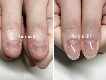 ハンド深爪矯正