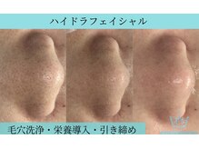 リメイククリニカルビューティー(Remake clinical beauty)/ハイドラフェイシャル