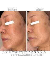 プレジール(Plaisir)/サーマトリックス＋ララピール