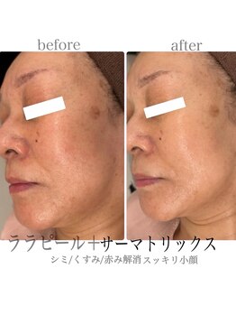 プレジール(Plaisir)/サーマトリックス＋ララピール