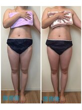 ローズ 下松(ROSE)/【筋膜リリース150分】