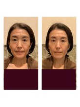 アクア エステティコ 亀有(ACQUA estetico)/シリカニードルピーリング　5回