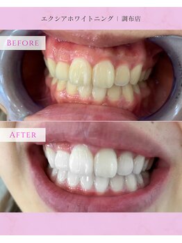エクシアホワイトニング 調布店/10代女性会員様/理想の白さに♪