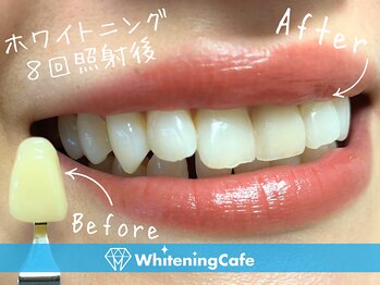 ホワイトニングカフェ 盛岡大通店(WhiteningCafe)/◎歯のホワイトニング施術写真◎