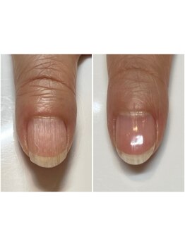 爪の悩みを解消できる（ケア含む）
