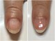 ブラウ ネイル パーティー(Blau Nail Party)の写真/[冬の乾燥,ささくれ,二枚爪,縦割れのお悩みに]深爪,巻き爪,噛み癖がある方,お爪を整える事が苦手な方にも◎