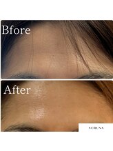 MMK/薄いシワにもハーブピーリング