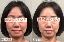 鍼灸院ひなた