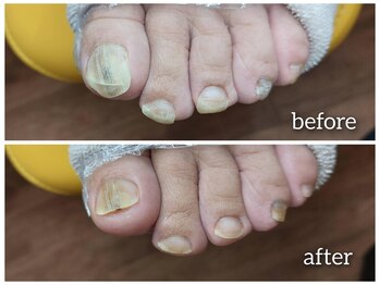 爪切り屋 足楽/お悩み「爪の変色・切れない」