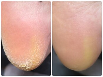 カルム 京都(Calme.)/ガチガチ踵もふわふわに