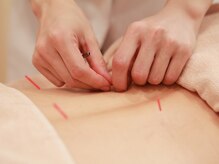 いちまる鍼灸院/頑固な肩こり根本改善　鍼灸ケア