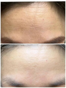 ハッテンビューティーパーク 神戸店(Hatten Beauty Park 810)/【ナノBirodo水光】