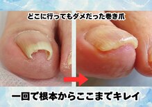 ここから巻き爪専門院