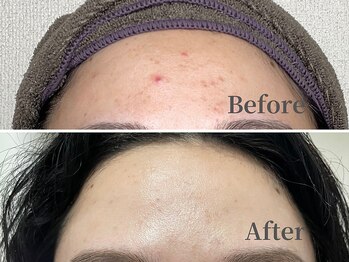 ハリニーク 銀座店(HARINIQ)/ハーブピーリング月2回施術