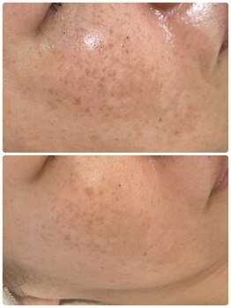 サラシック(salachic)/シミケア悩み