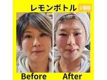 アン 銀座(ann)/レモンボトル　2回目