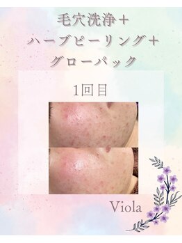 ビオラ(viola)/ニキビ・強い赤みが気になる方!