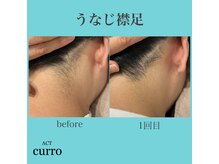 アクト クロ(ACT curro)/【うなじ襟足】脱毛施術例