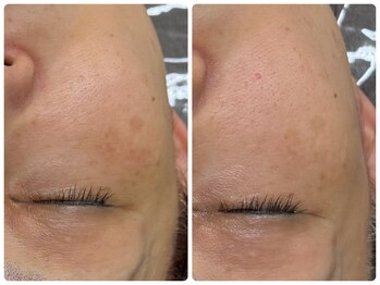 シェミー(CHEZ MEE)/シミに働きかけアプローチ*乾燥